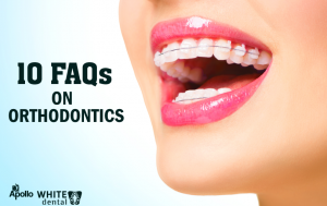 10 FAQs On Orthodontics